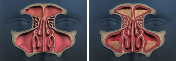 Sinusitis vs normal sinus